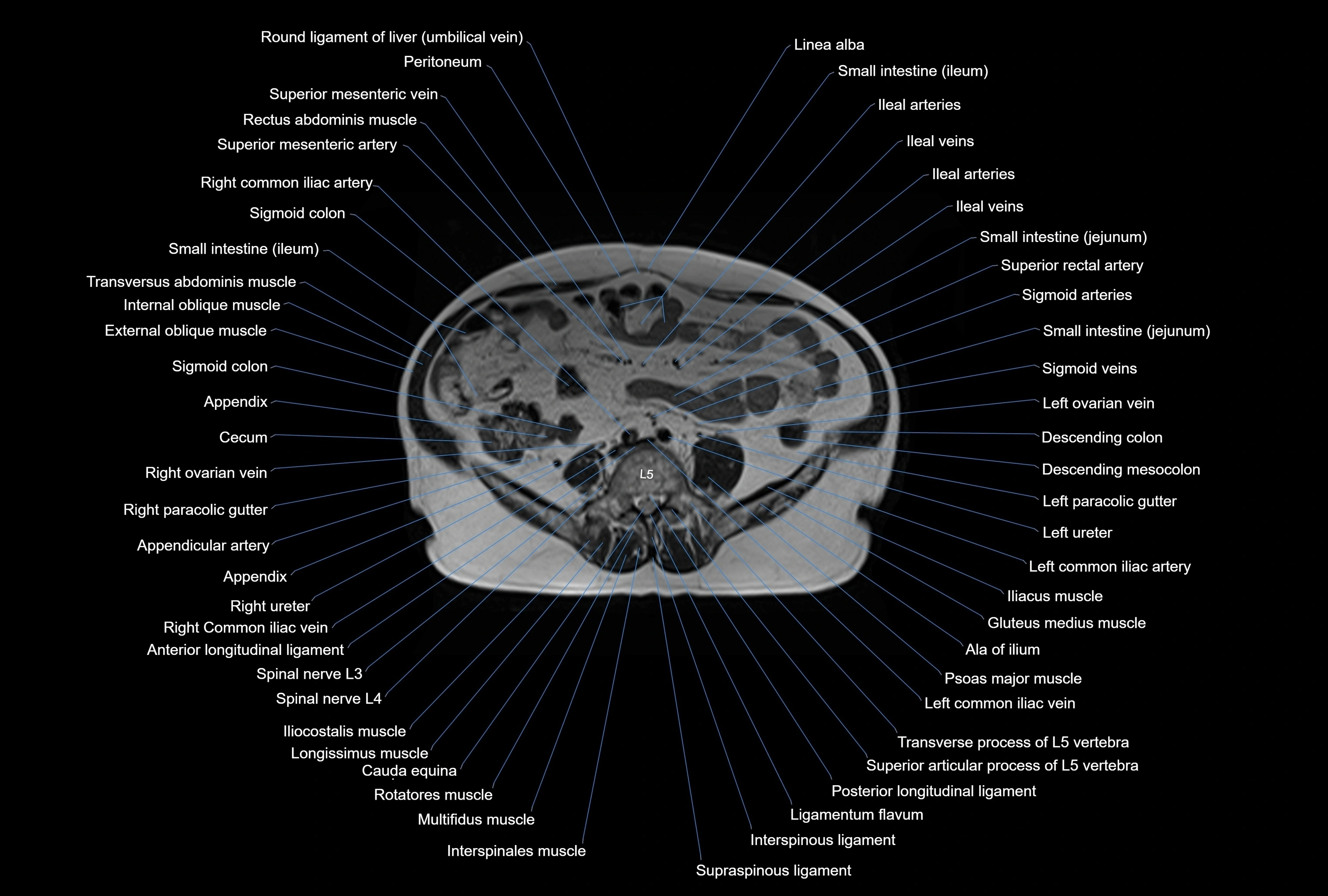 MRI Abdomen axial cross sectional anatomy radiology  image-img-00001-00035.webp